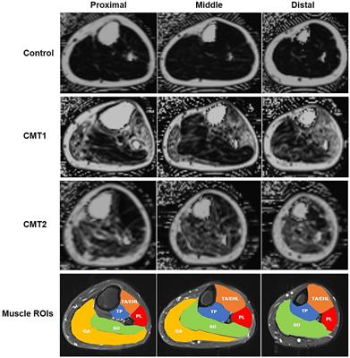 Quantified fat fraction as biomarker assessing disease severity in rare Charcot–Marie–Tooth subtypes